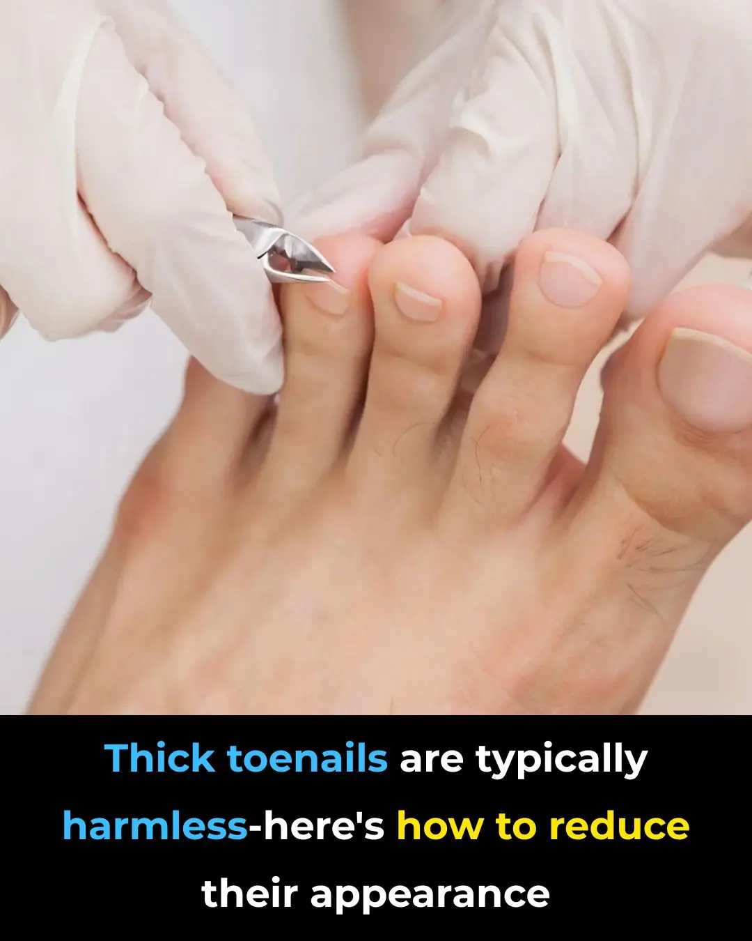 Why Thick Toenails Happen, And How To Get Rid of Them
