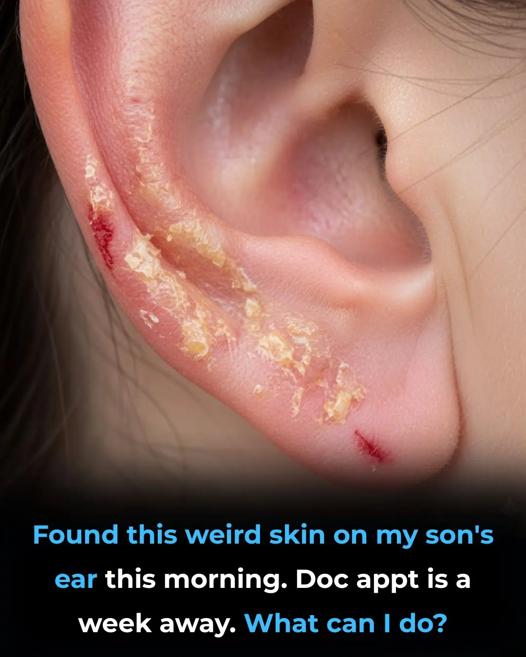 Found this weird skin on my son's ear this morning. Doc appt is a week away. What can I do?