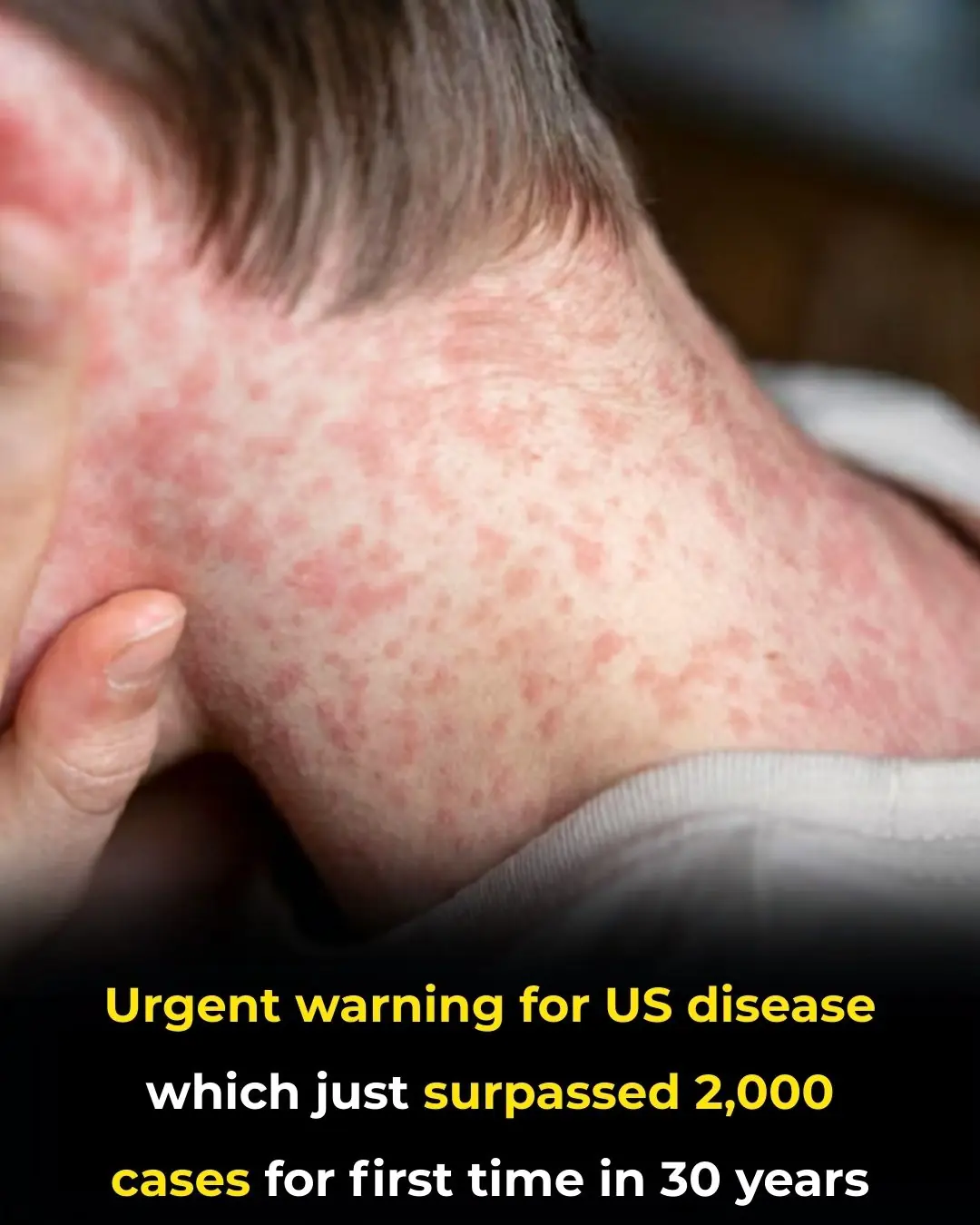 Measles Cases Hit 30-Year High in the US, Raising Urgent Public Health Concerns