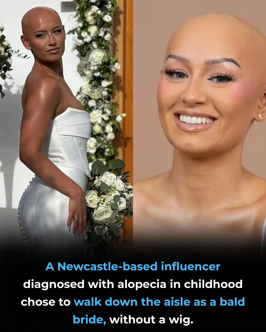 Bride Embraces Alopecia, Walks Down Aisle Wig-Free to Celebrate Authenticity
