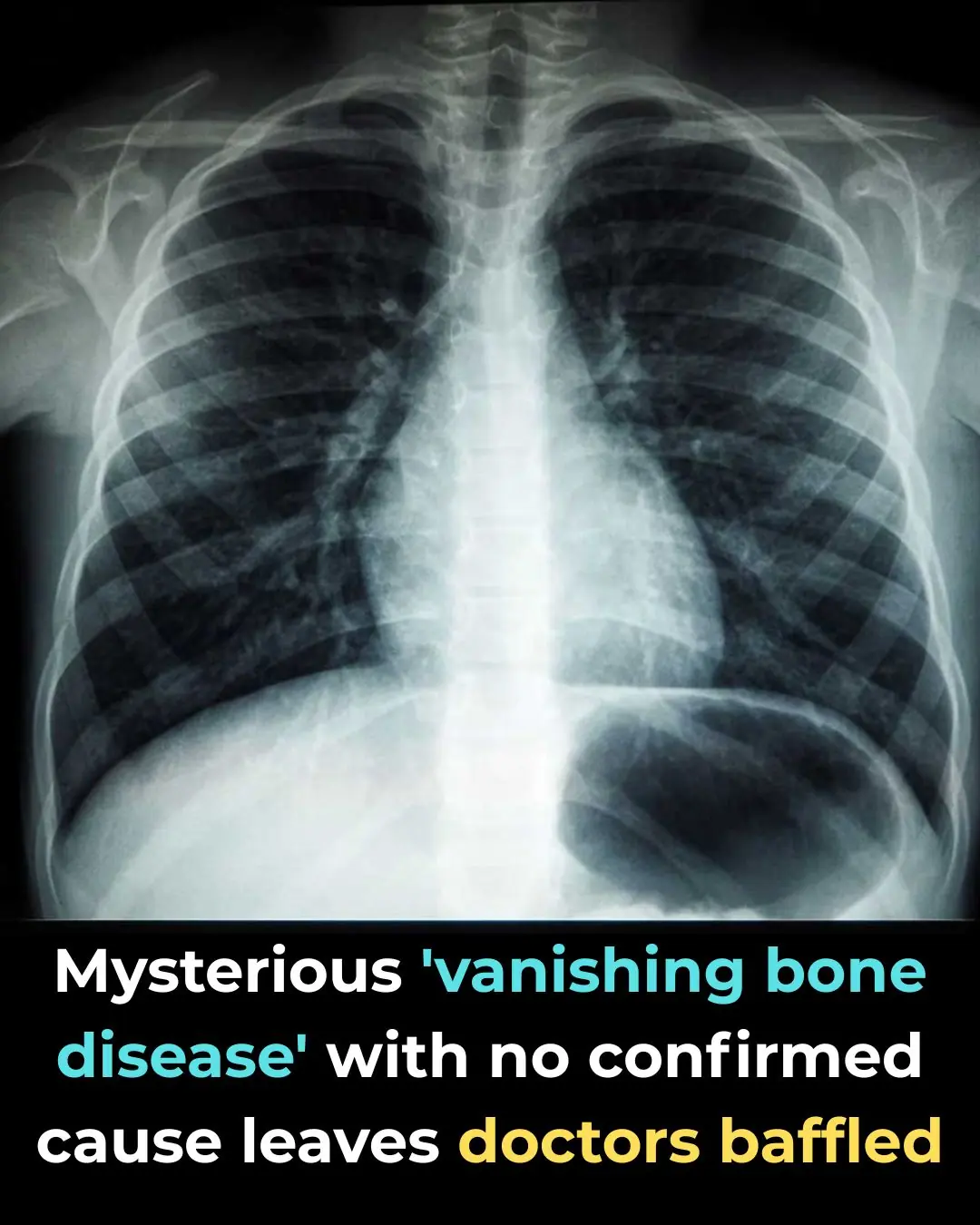 The Rare Condition That Makes Human Bones Slowly Vanish