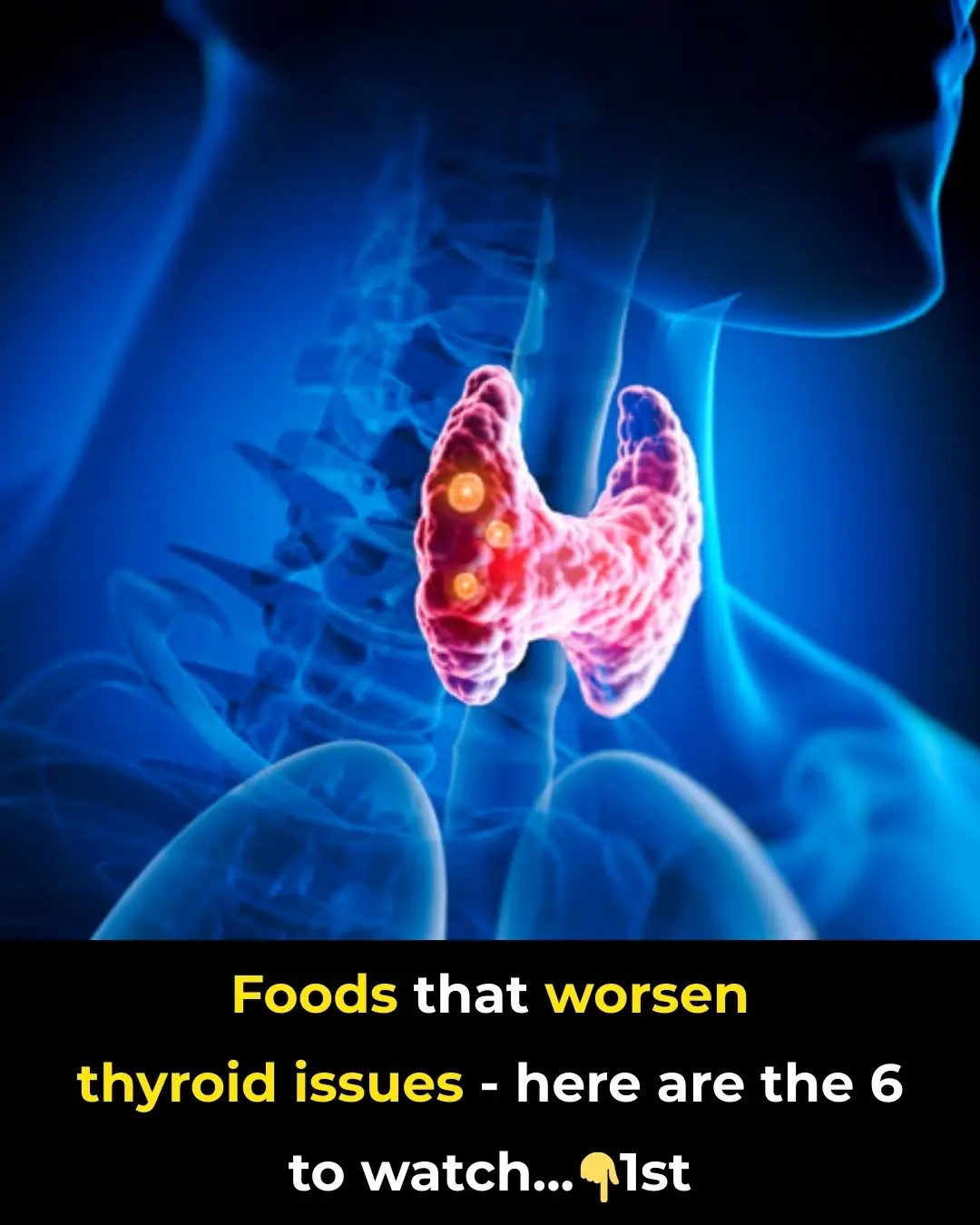 6 Foods You Absolutely Need To Avoid If You Suffer From a Thyroid Disorder
