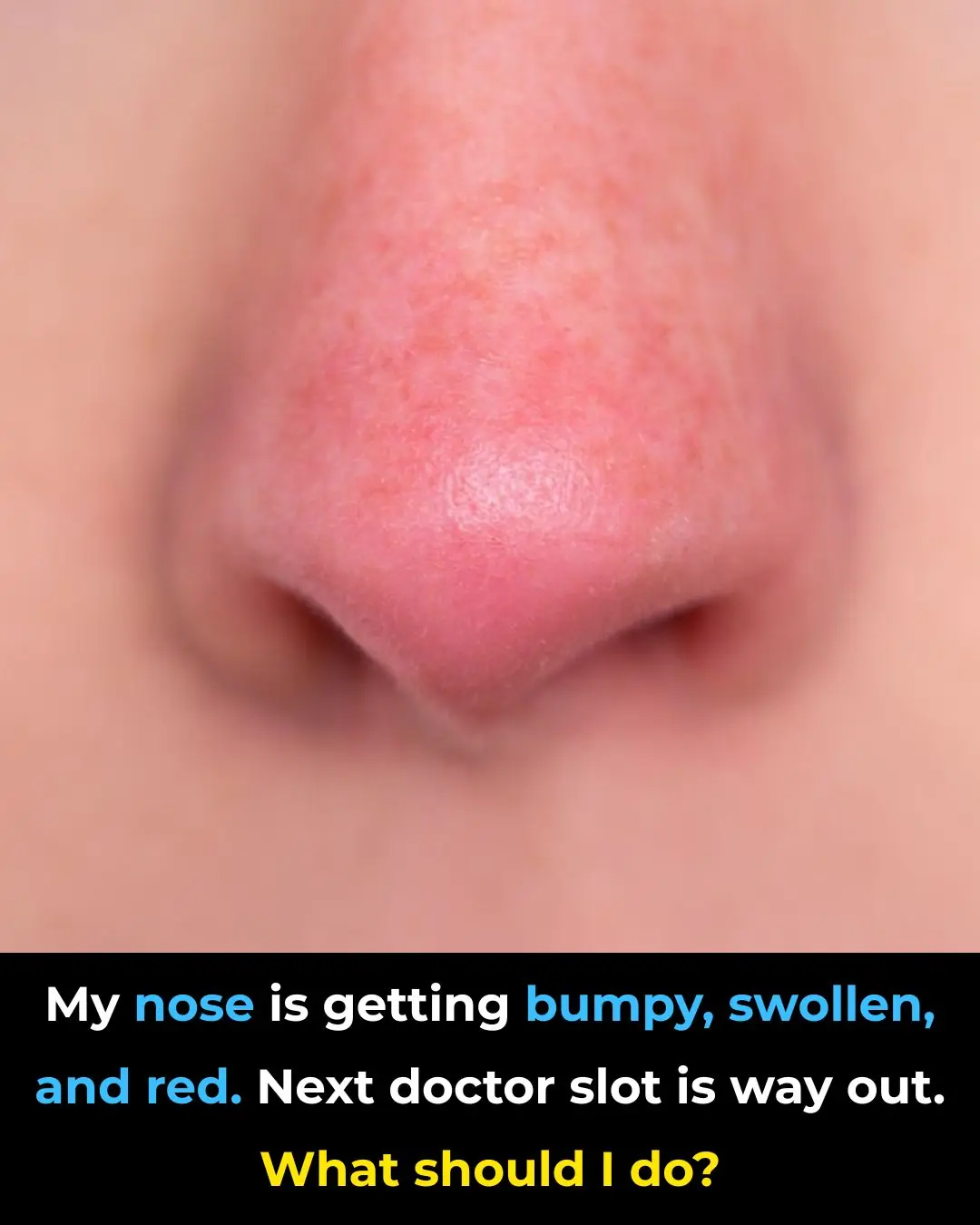 My nose is getting bumpy, swollen, and red. Next doctor slot is way out. What should I do?