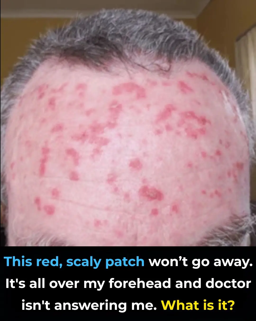 This red, scaly patch won’t go away. It's all over my forehead and doctor isn't answering me. What is it?