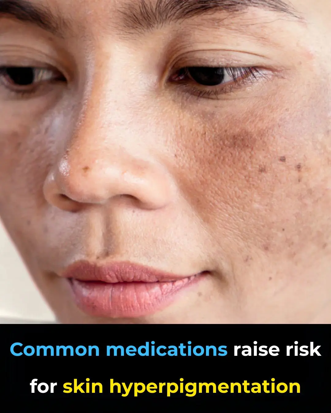 Common Medications Linked to Increased Risk of Skin Hyperpigmentation