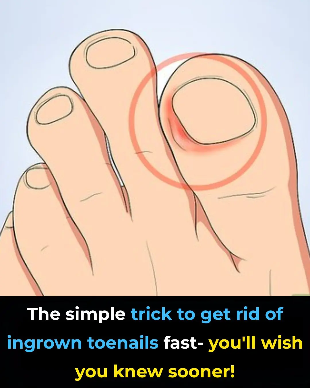 Home Remedies to Get Rid Of Ingrown Toenails (Onychocryptosis)
