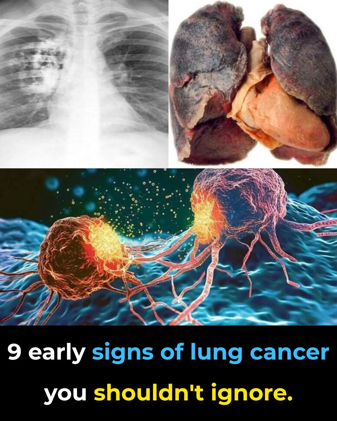 9 Early Warning Signs of Lung Cancer You Should Not Ignore