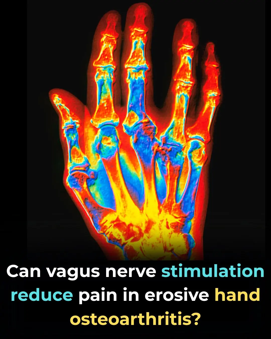Can Transcutaneous Auricular Vagus Nerve Stimulation Reduce Pain in Erosive Hand Osteoarthritis?