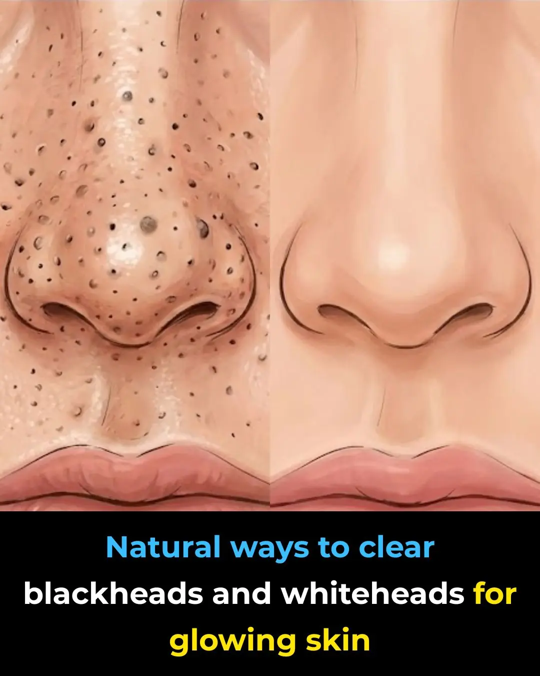 Natural Ways to Clear Blackheads and Whiteheads