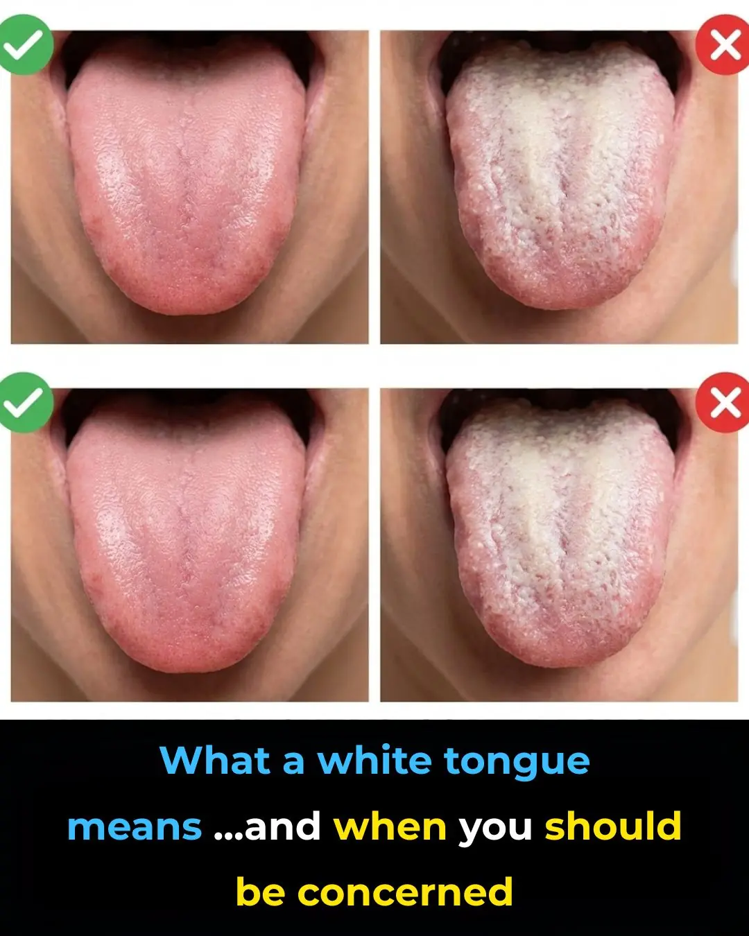 What a White Tongue Means