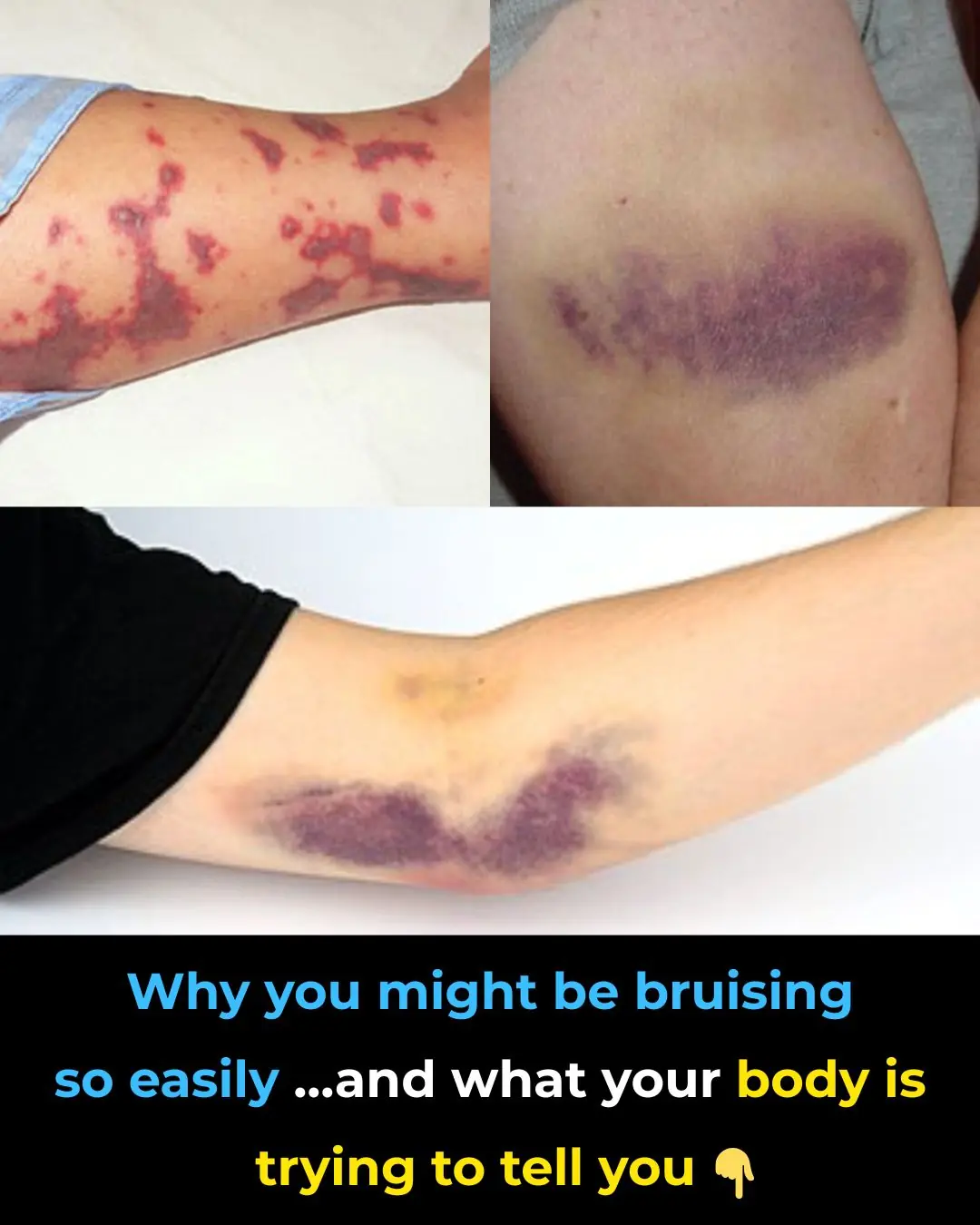 Why You Might Be Bruising So Easily