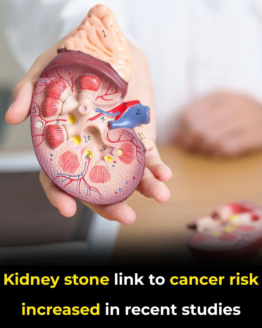 Kidney Stones and Cancer Risk: What Recent Studies Are Revealing
