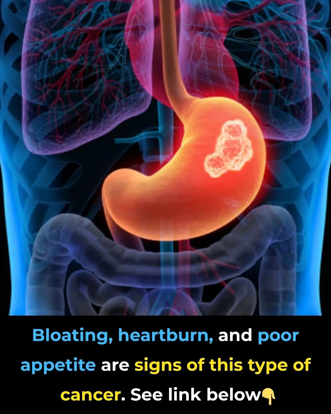 What Is Stomach Cancer?