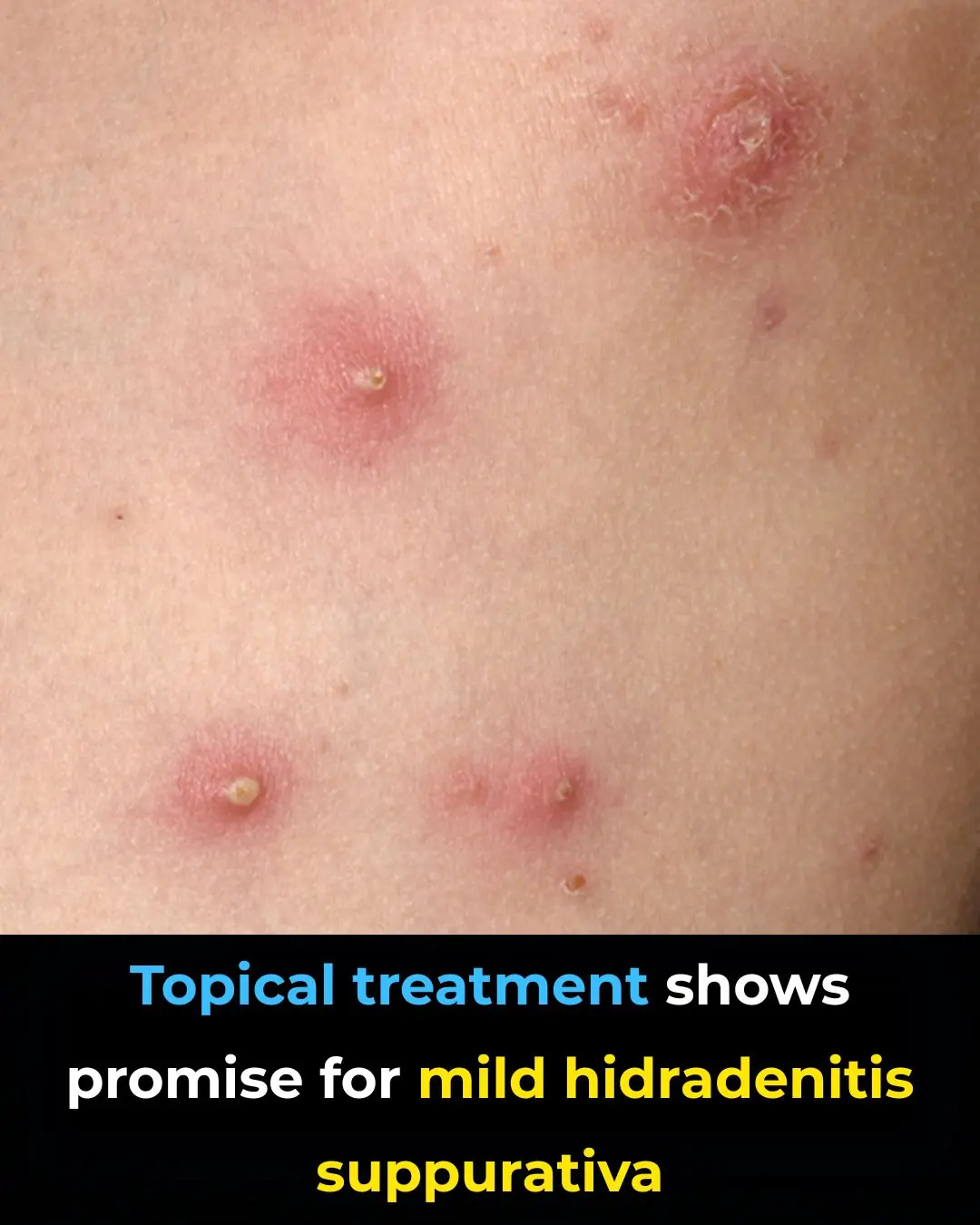Can Anti-Inflammatory Topical Therapy Fill the Treatment Gap in Mild Hidradenitis Suppurativa?