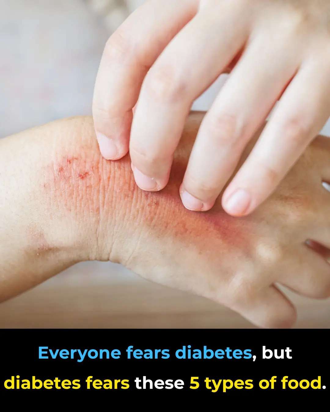 Everyone Fears Diabetes, but Diabetes “Fears” These 5 Foods