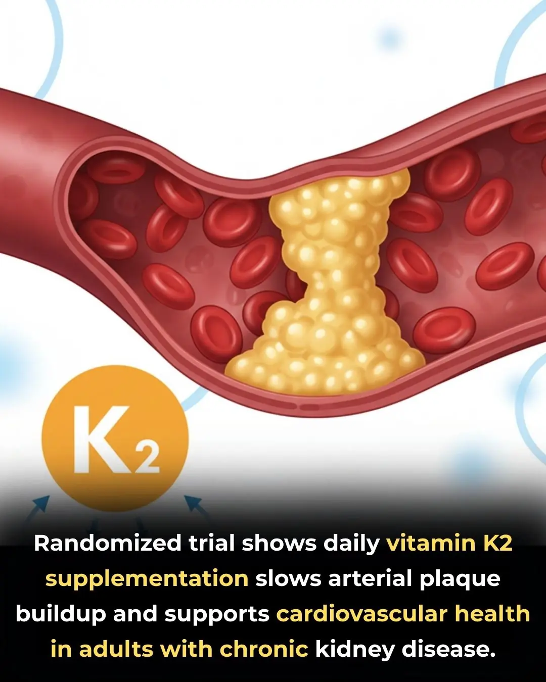 Vitamin K2 Supplementation Slows Arterial Plaque Progression in Chronic Kidney Disease