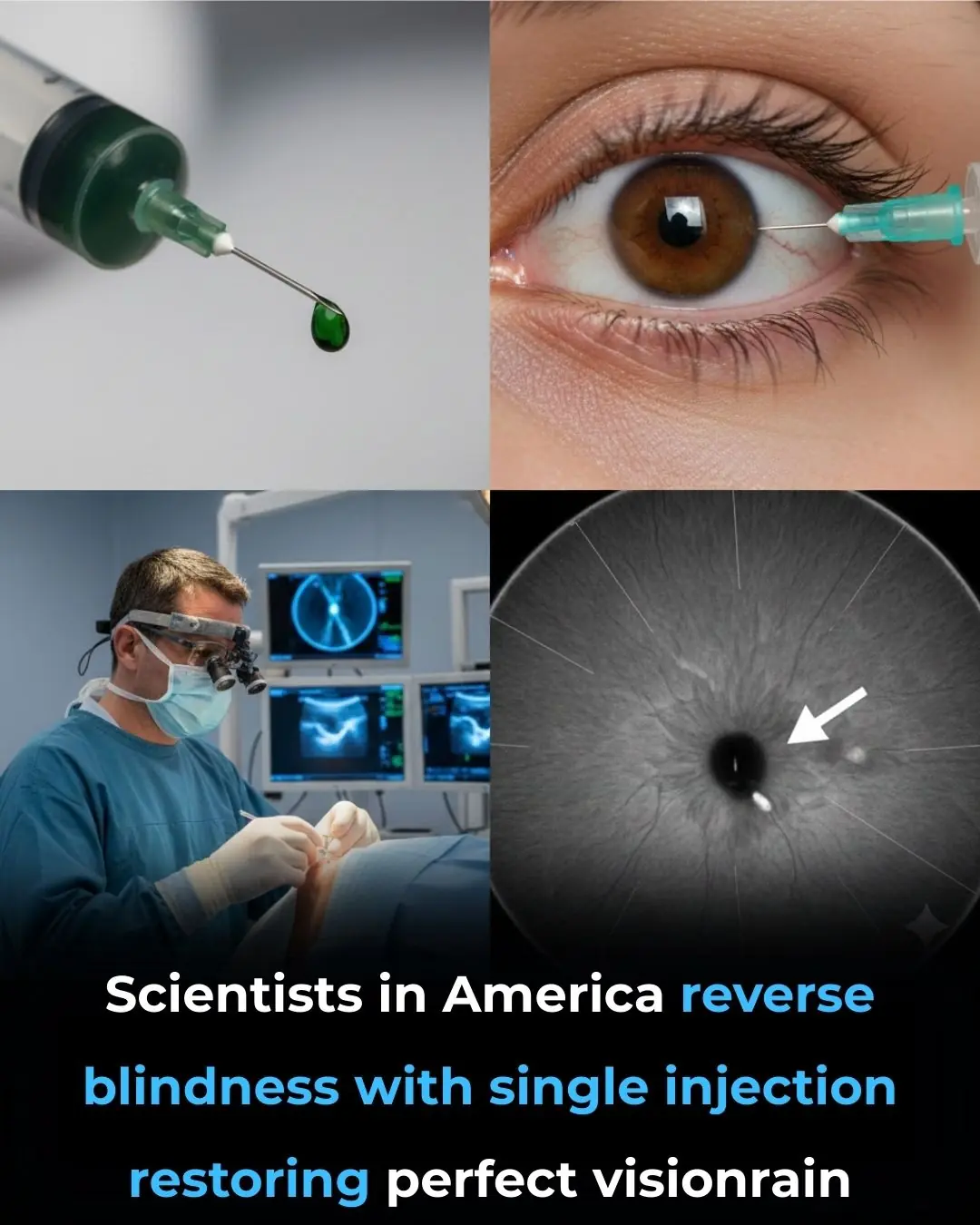 Single-Injection Gene Therapy Restores Vision in Patients With Inherited Blindness