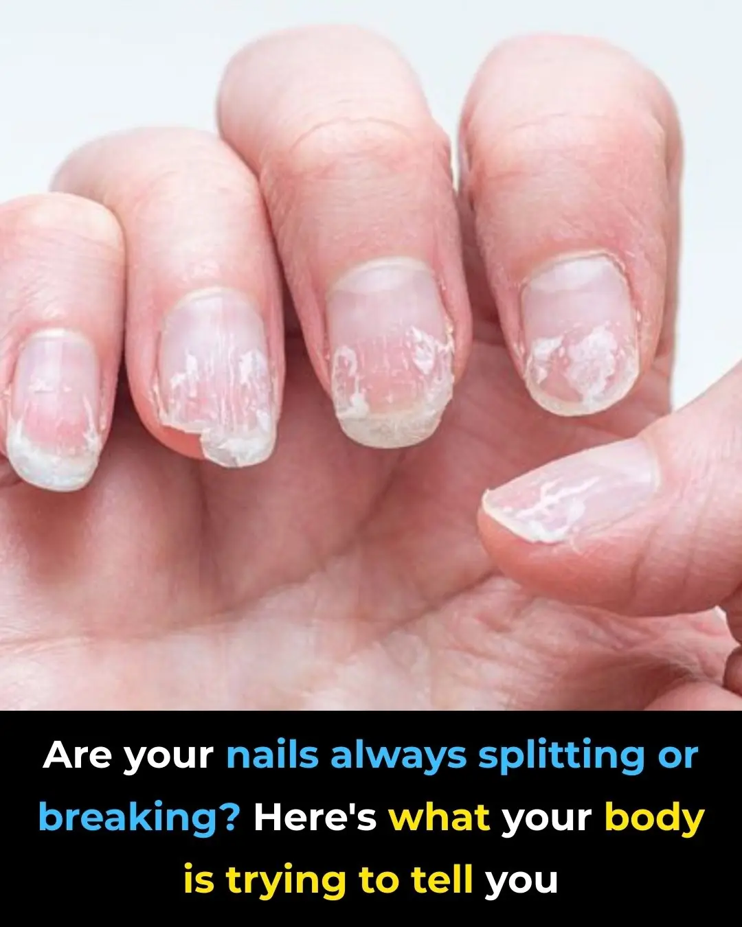 What Weak or Brittle Nails May Be Telling You About Your Health