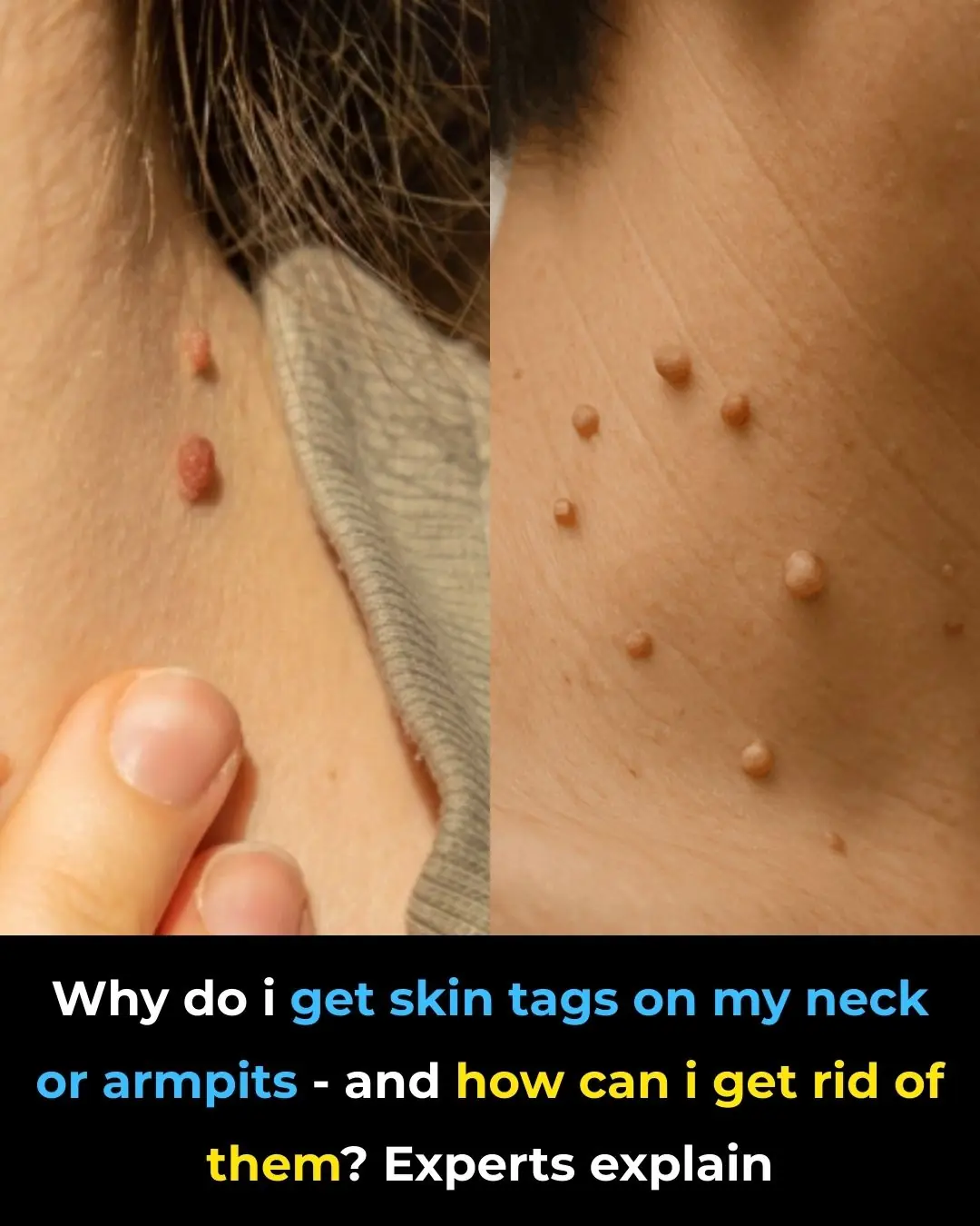 Why Do I Get Skin Tags on My Neck or Armpits—and How Can I Get Rid of Them? Experts Explain