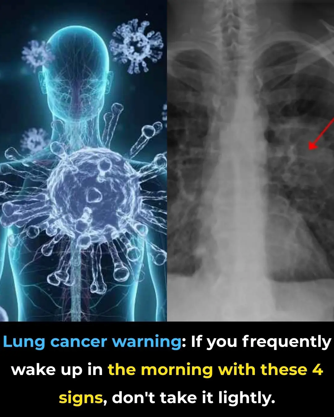 Lung Cancer Warning Signs: If You Often Notice These 4 Symptoms in the Morning, Don’t Ignore Them