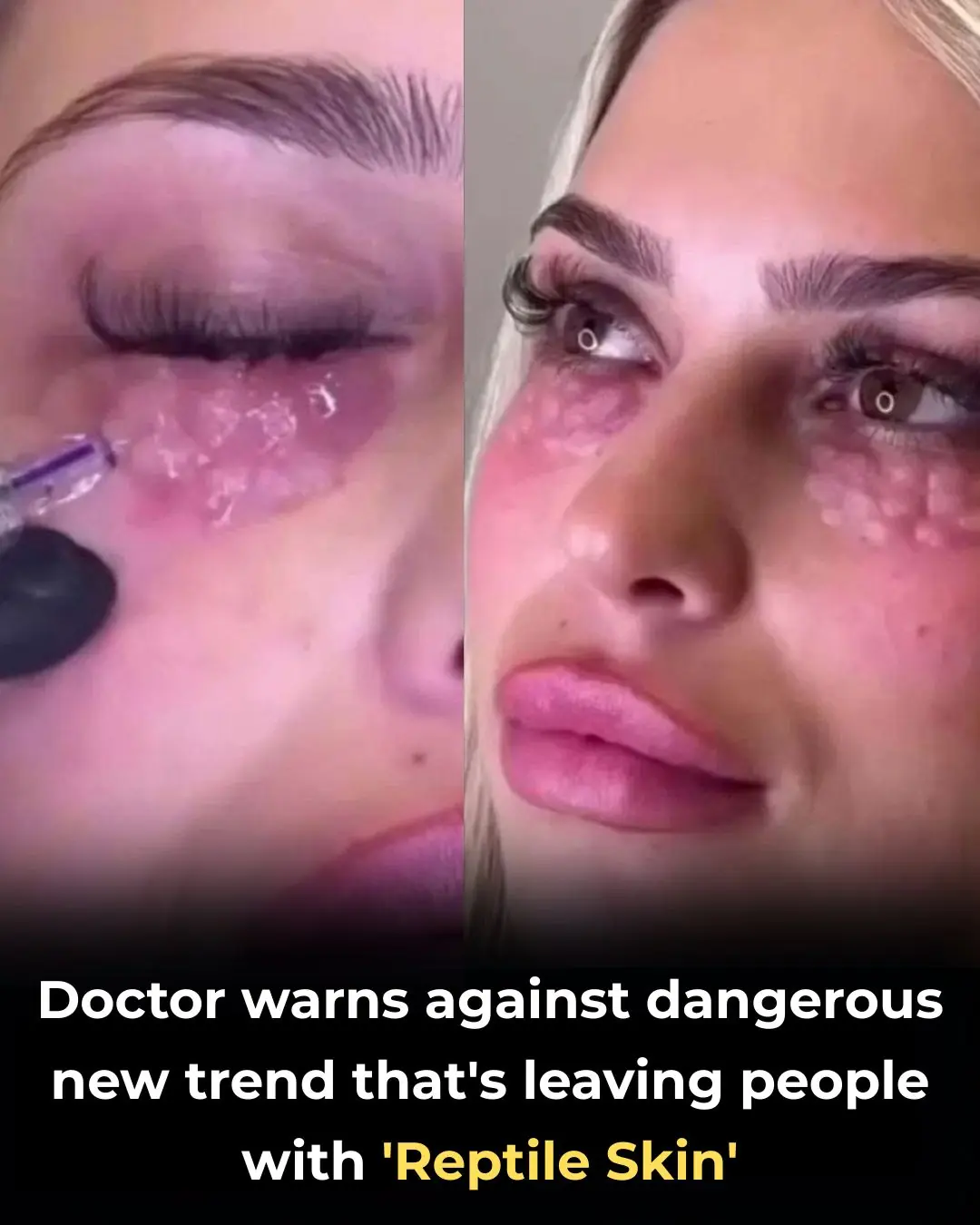 Doctor Warns of Mesotherapy’s Risky Side, Causing Reptile-Like Skin