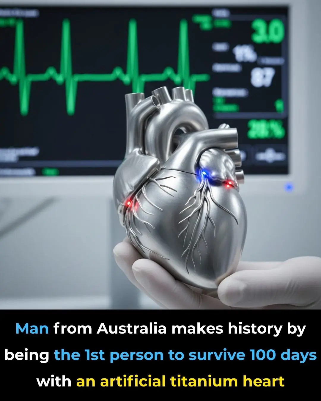 Australian Man Makes Medical History by Surviving Over 100 Days with an Artificial Titanium Heart Before Transplant