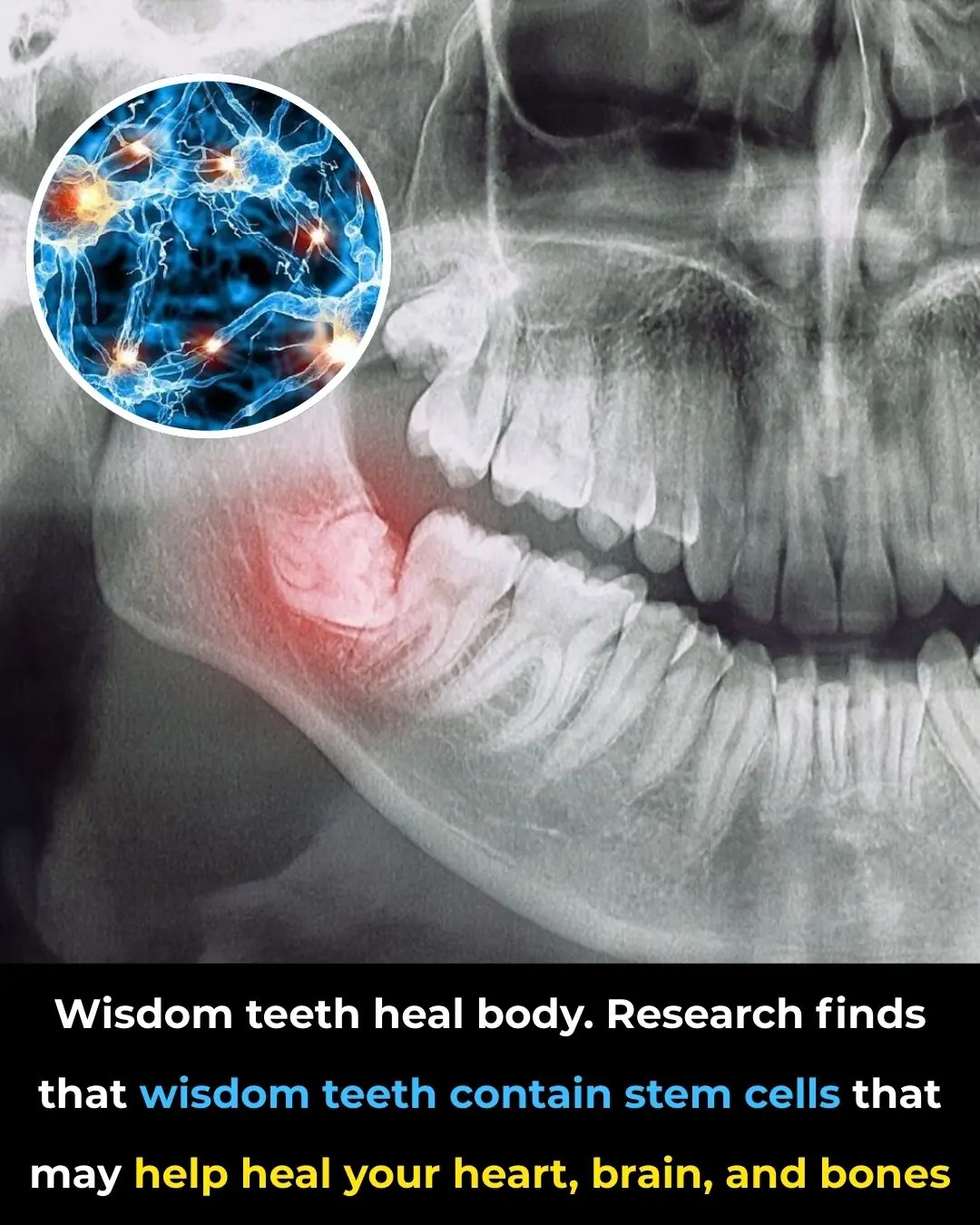 Wisdom Teeth: A Hidden Treasure for Regenerative Medicine 🦷✨