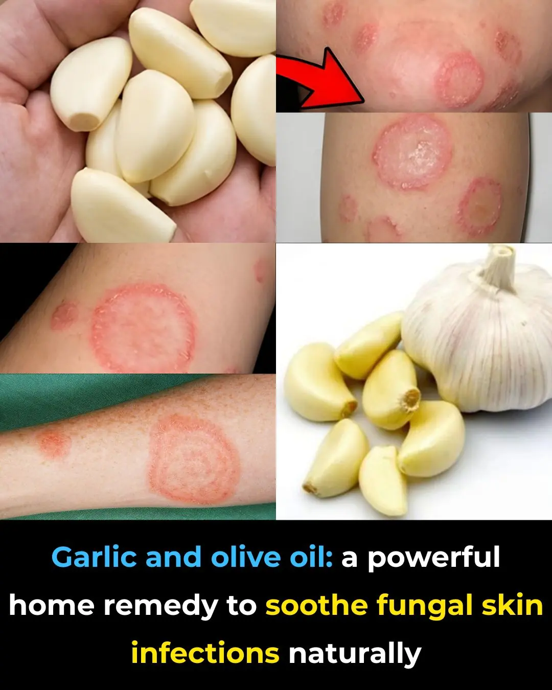 Garlic and Olive Oil: A Natural Way to Soothe Annoying Fungal Skin Infections at Home