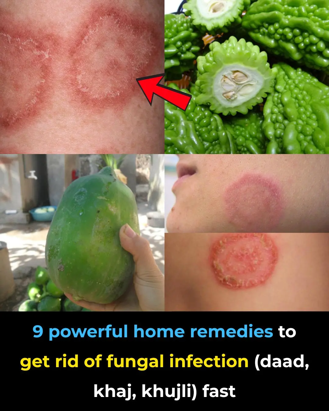 9 Powerful Home Remedies to Eliminate Fungal Infections (Daad, Khaj, Khujli) Naturally and Fast