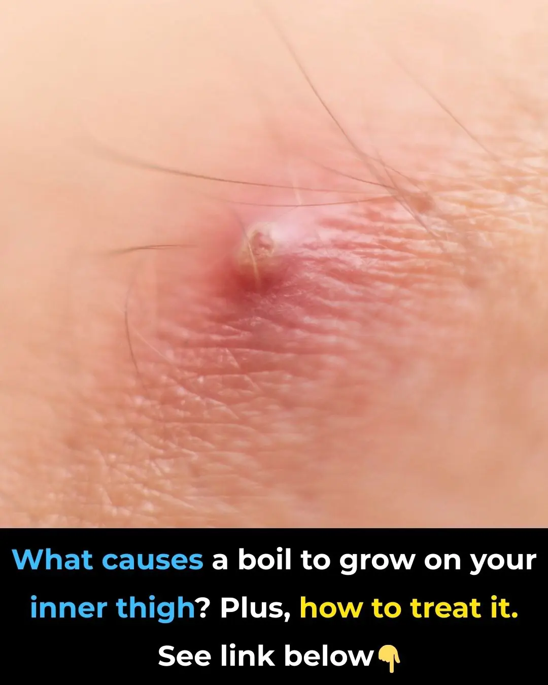 Boil on Inner Thigh: Symptoms and Treatment Options