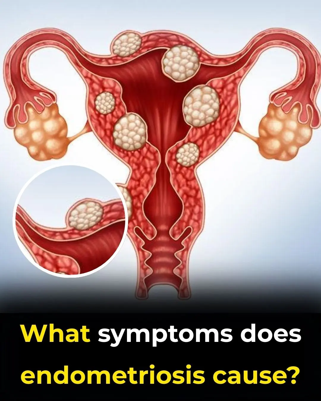 Understanding Endometriosis: Symptoms, Diagnosis, and the Importance of Early Detection with Dr. Pau Zúñiga