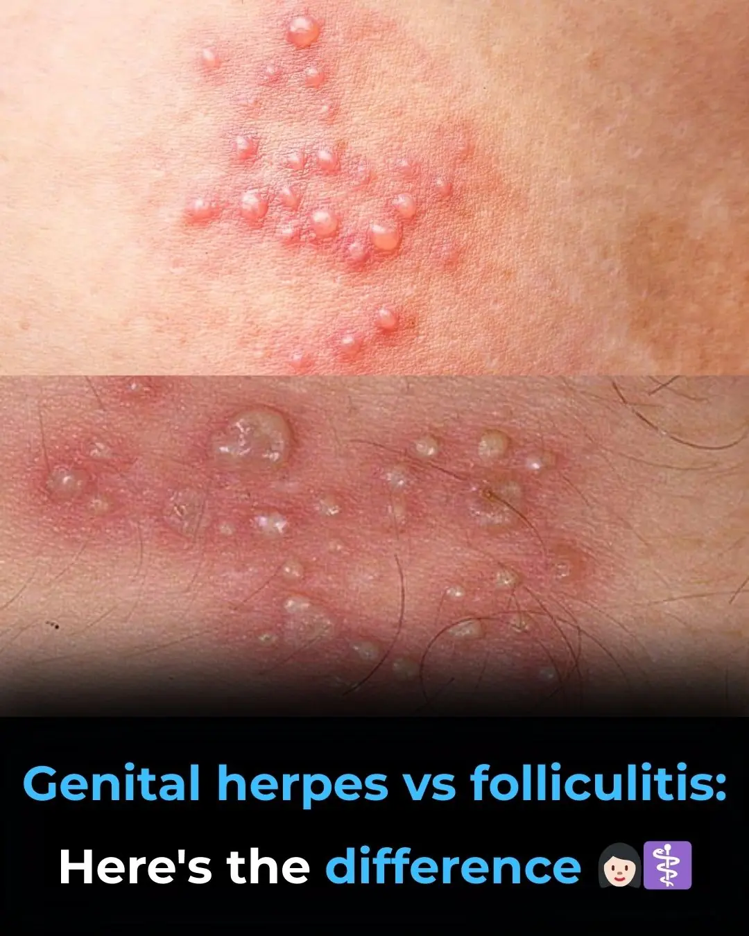 Genital Herpes vs Folliculitis: Understanding the Difference 👩🏻‍⚕️