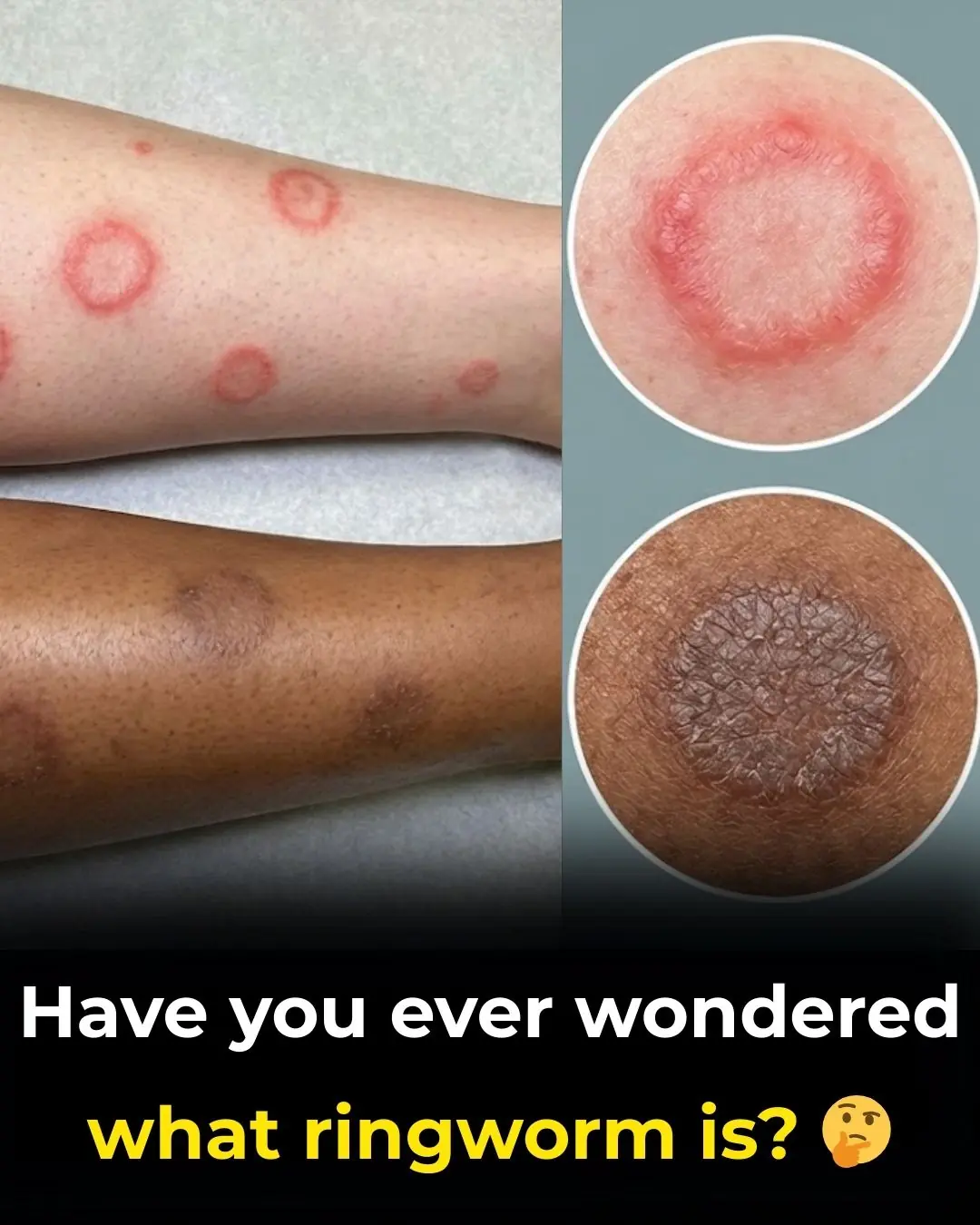 Understanding Ringworm: Causes, Symptoms, Transmission, and the Importance of Medical Evaluation