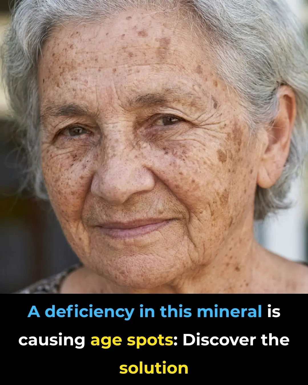The Lack of This Mineral Is Causing Age Spots: Discover the Solution