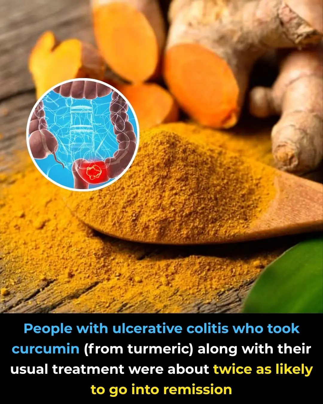 Curcumin Shows Promise in Helping Ulcerative Colitis Patients Achieve Remission