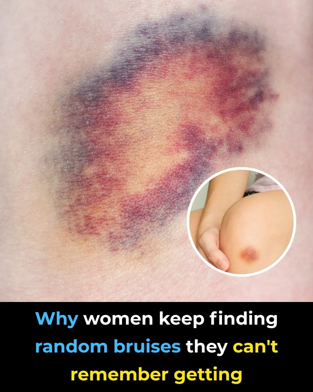 Why You Wake Up with Bruises