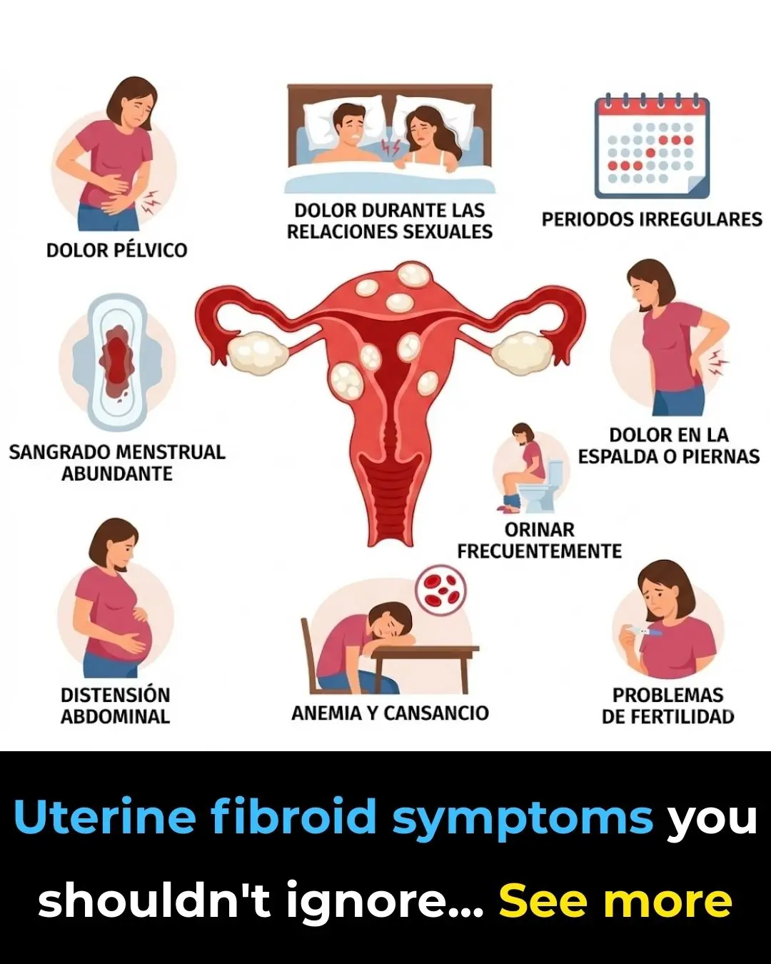 Uterine fibroids: 5 things we should know