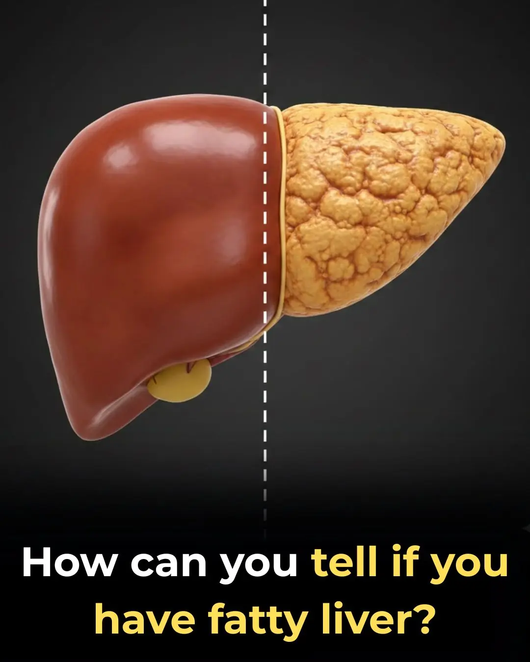 Understanding Fatty Liver Disease: Risk Factors and Early Signs