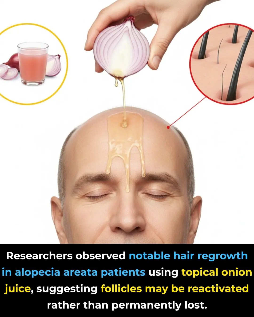 Onion Juice and Alopecia Areata: Expanded Overview