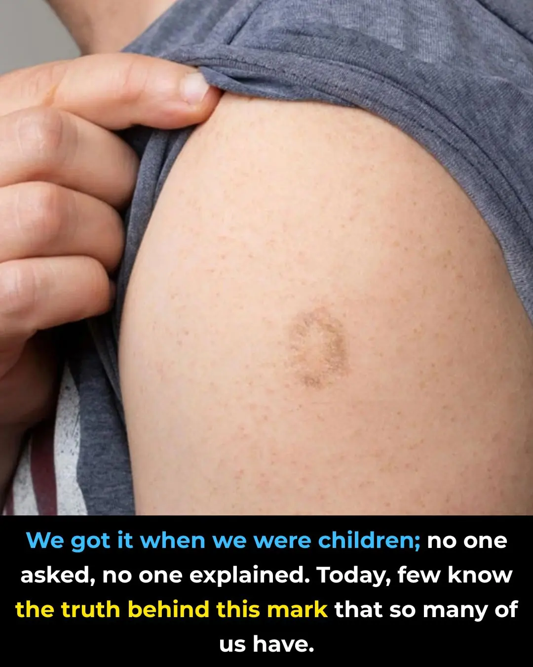 Here's The Truth Behind This Scar On People's Upper Left Arm