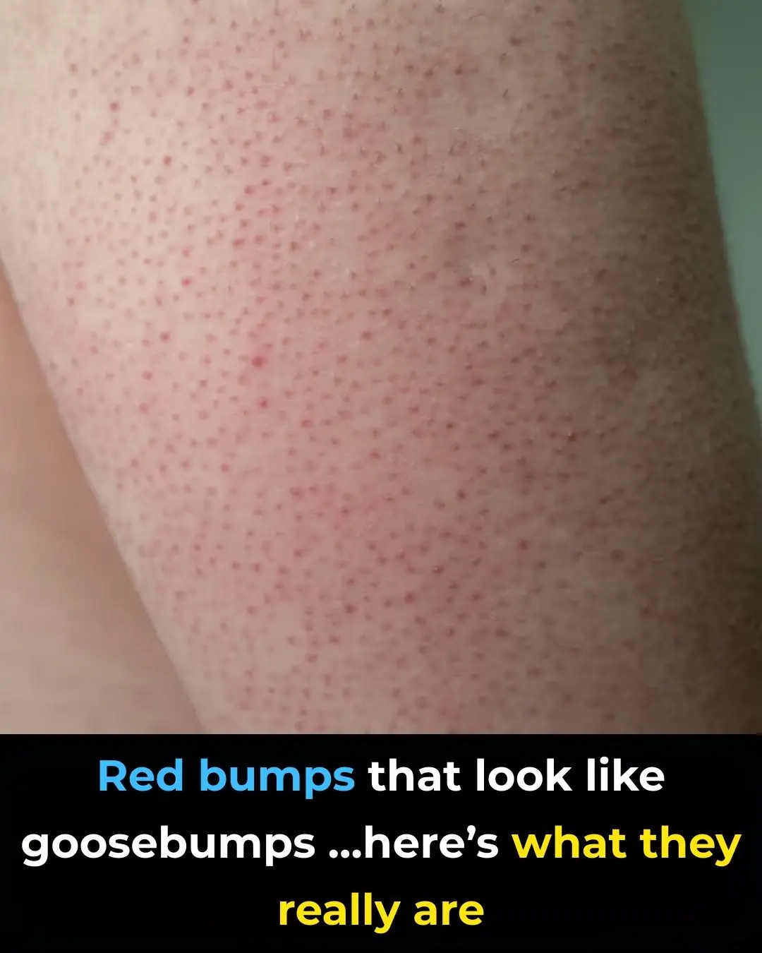 Red Bumps That Look Like Goosebumps