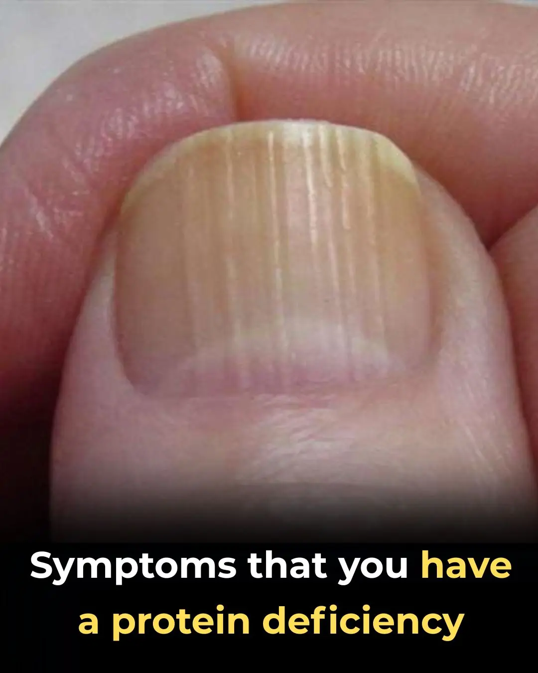 10 signs in your body that reveal a deficient protein intake