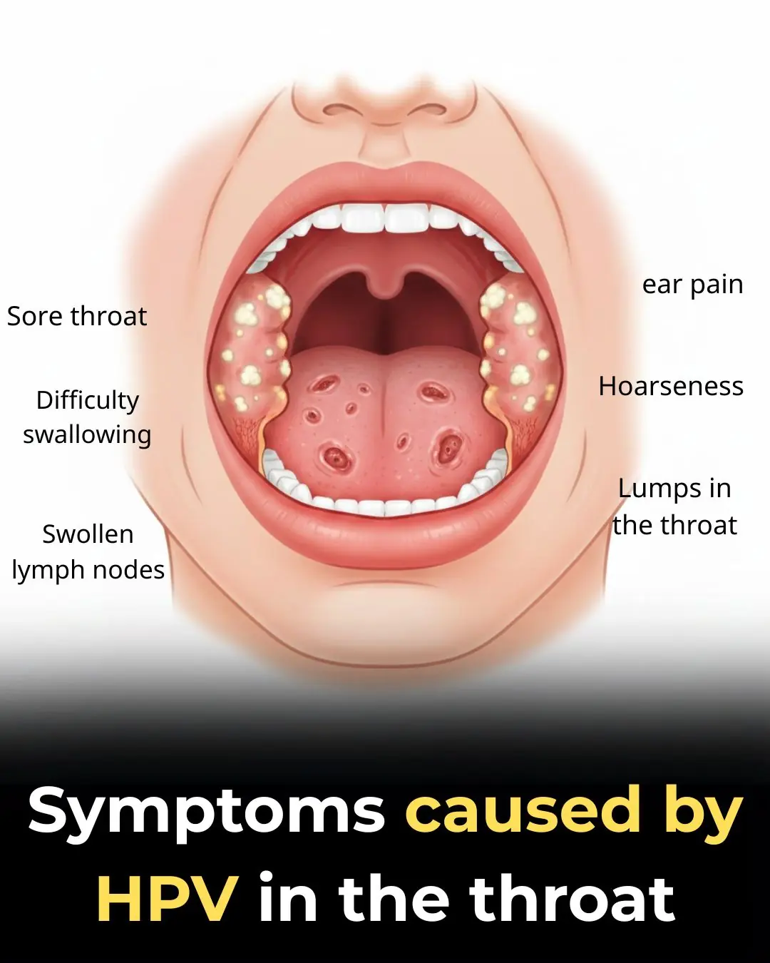 What Symptoms Does HPV Cause in the Throat?