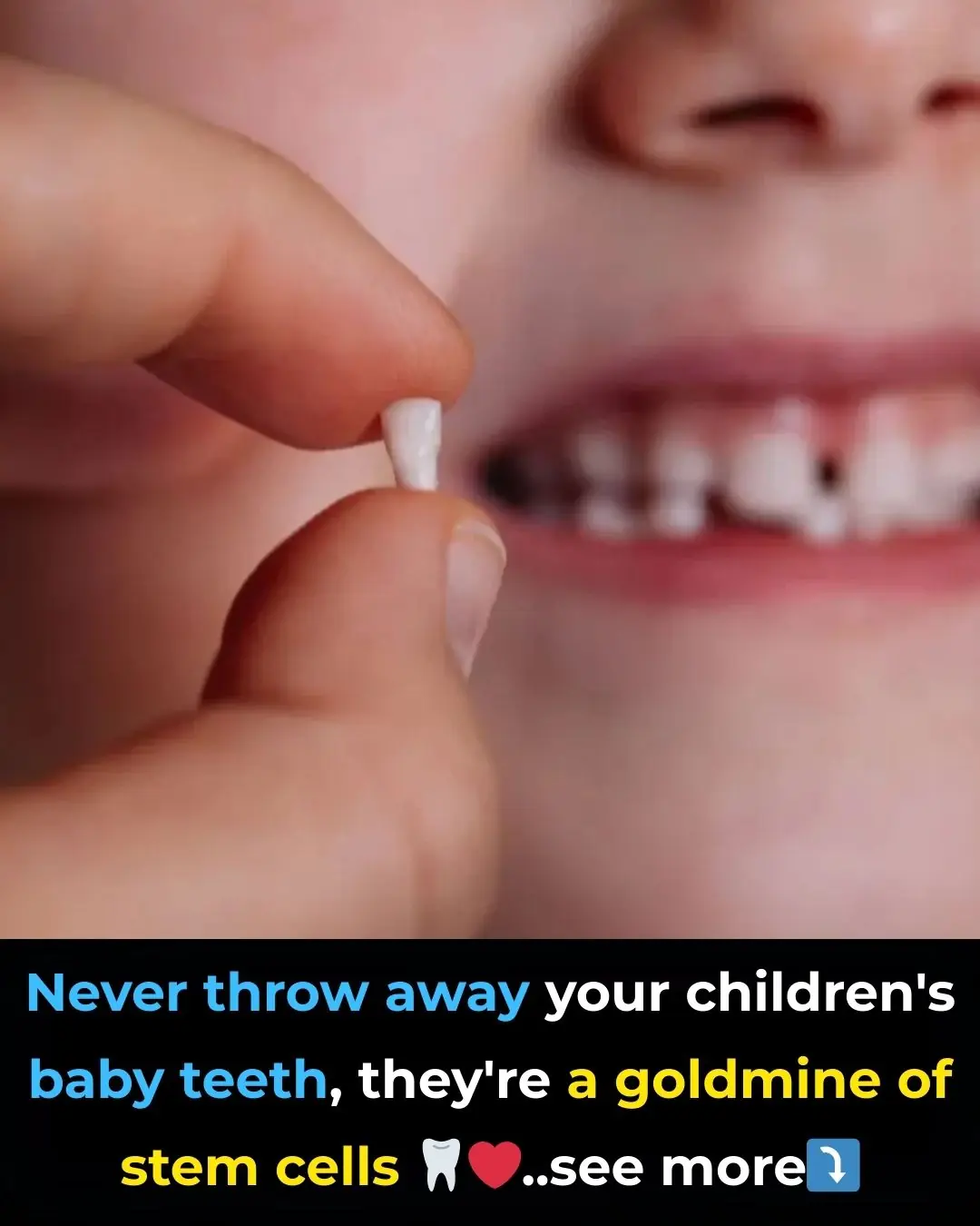 Save your child's 'baby teeth', they are a goldmine of stem cells