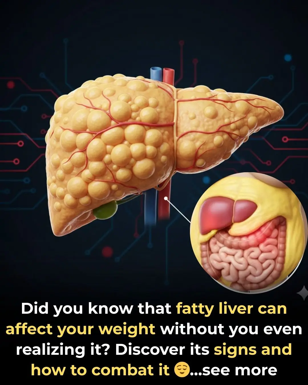 Fatty Liver: Symptoms, Types, Causes, and Treatment