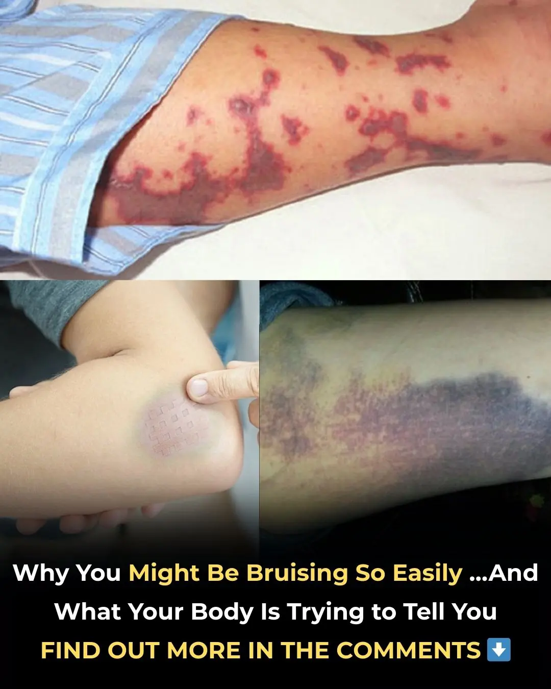 Why You Might Be Bruising So Easily