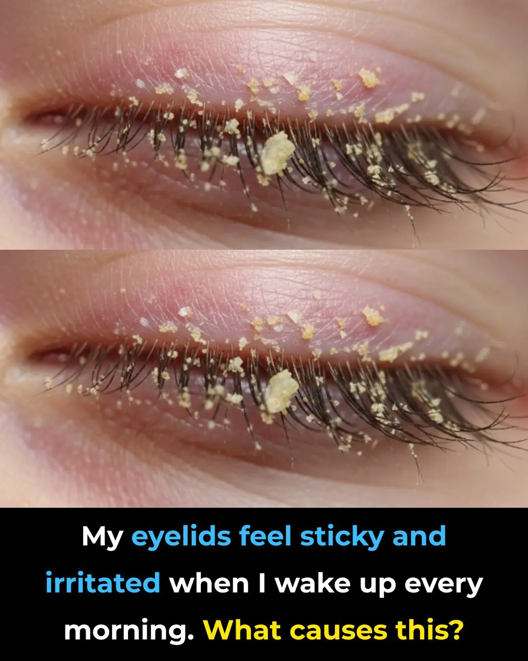 My eyelids feel sticky and irritated when I wake up every morning. What causes this?