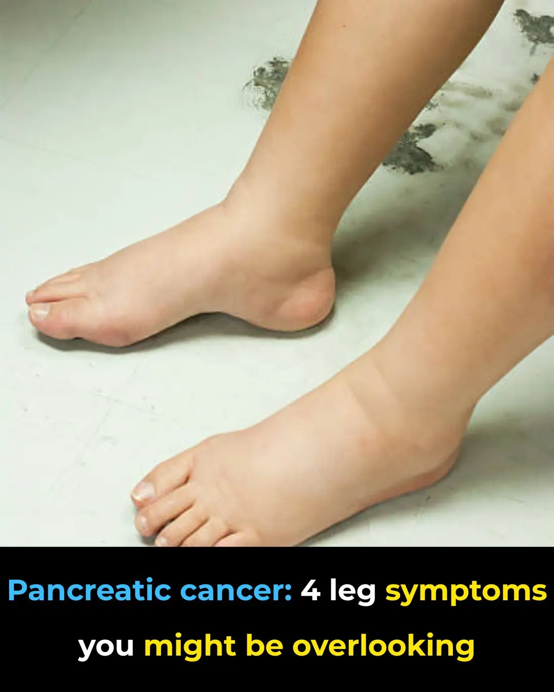 The Silent Signal: What Your Legs May Reveal About Pancreatic Health