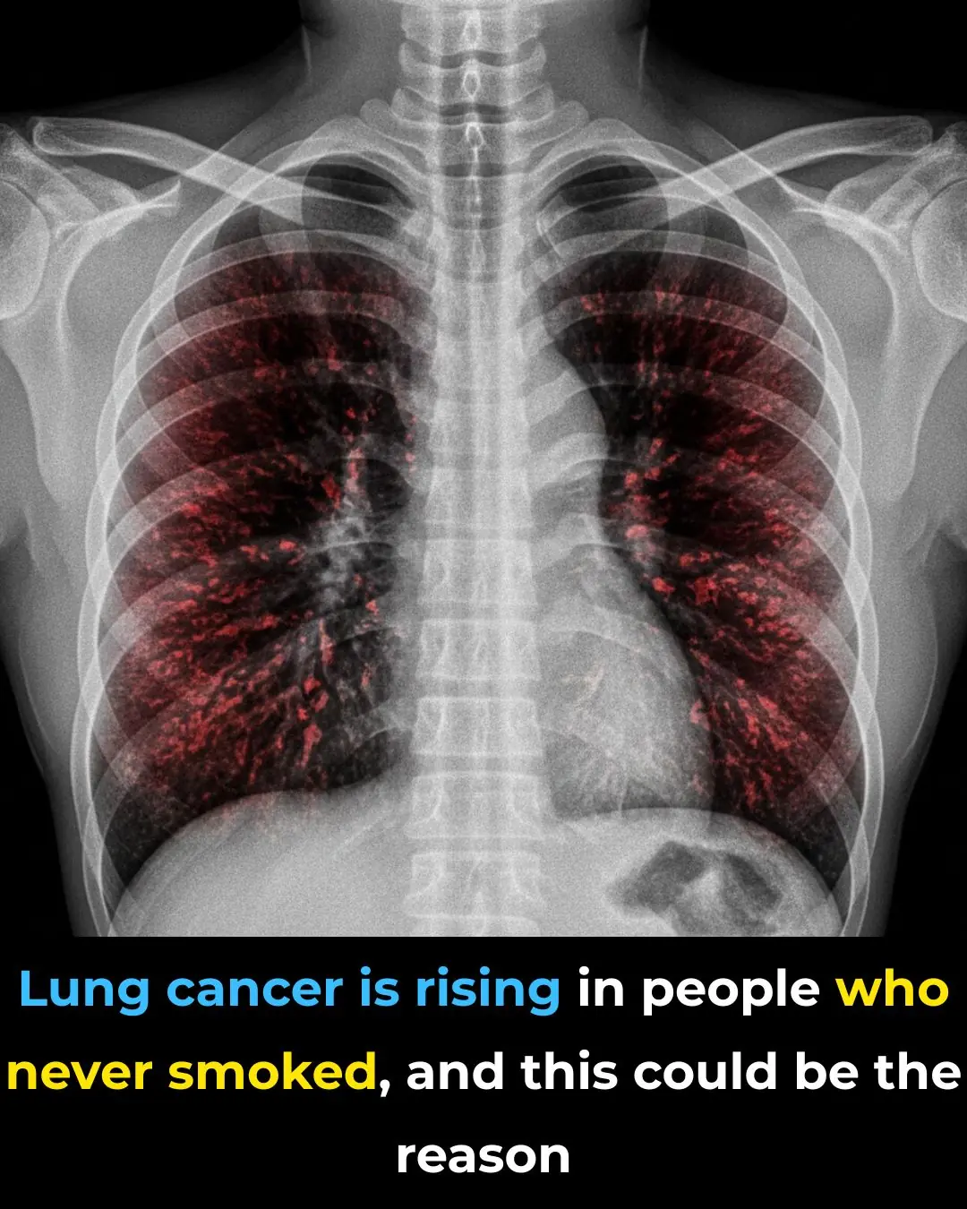 This Could Be Why Lung Cancer Is Rising in People Who Never Smoked