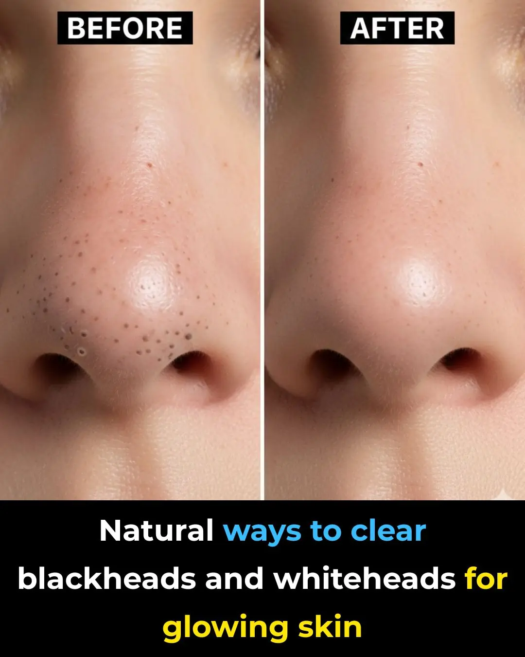 Natural Ways to Clear Blackheads and Whiteheads